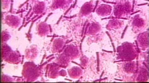 Smallpox Vials Discovered in Lab Storage Room, CDC Says