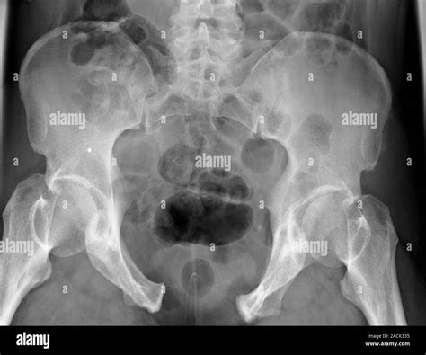 Pelvic fracture. X-ray of the pelvis of a 61 year old male patient with ...