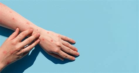 WHO to decide whether monkeypox represents public health emergency