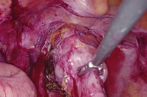 Laparoscopic discoid rectal resection as surgical treatment for endometrial cancer recurrence ...