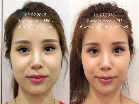 Face Reshaping Fillers at James Tarvin blog