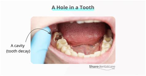 Image result for Tooth Hole