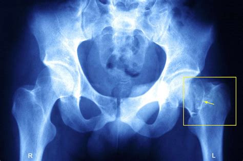 Hip Fracture Types and Complications