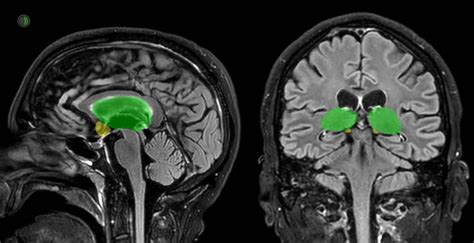 Coma Fundamentals - Neuroresus
