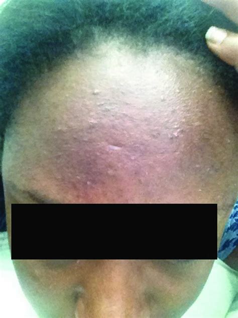 Fungal Acne Forehead