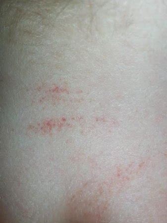 Dr. BHB is this petechiae? | BabyCenter