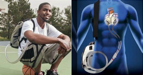 This 25 Year Old Lived Happily With His Heart In His Backpack For 1.5 Years