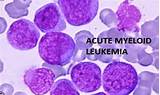 American Society of Hematology releases new guidelines for treating AML ...