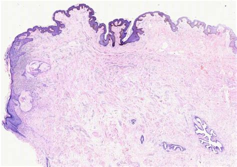 Dermatopathology Society of India: Image of the Month