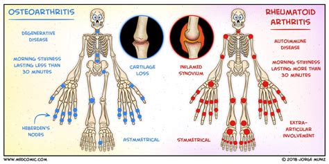 Osteoarthritis vs. Rheumatoid Arthritis | MedComic