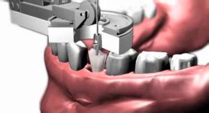 Image result for New Technology Tooth Extraction