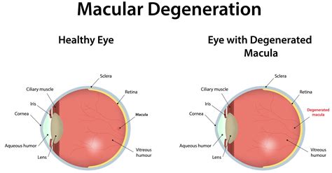 Macular Degeneration Overview | Eye Patient