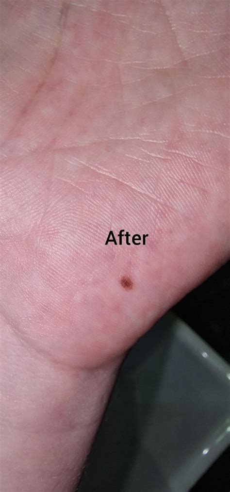 Mole on Palm - suspicious? : r/Melanoma