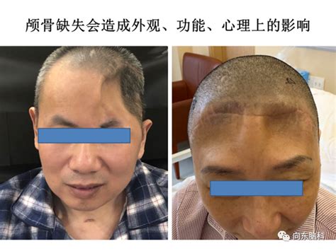 老人花10元剃头后满头伤口最新素材