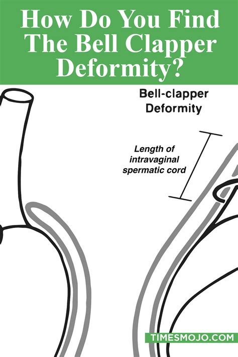 How do you find the bell clapper deformity? - TimesMojo