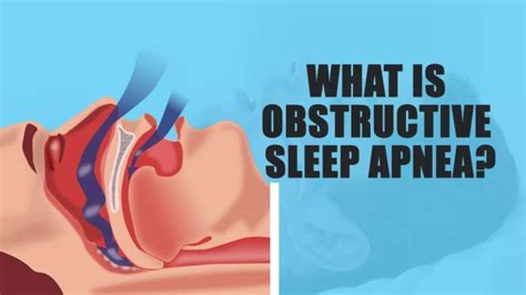 OBSTRUCTIVE SLEEP APNOEA