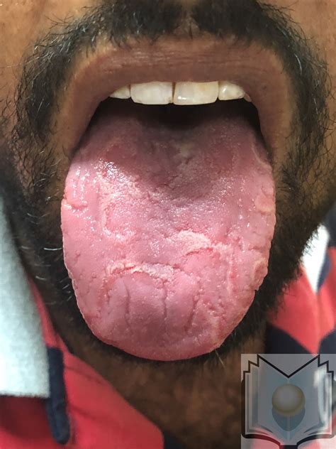 Geographic Tongue Treatment