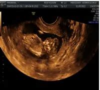 Caso de éxito de anencefalia - Medicover Hospital