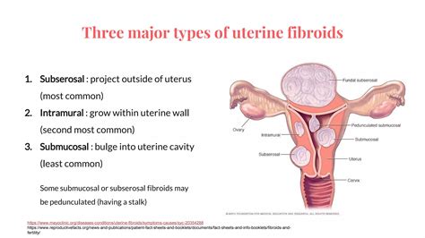 Diagnostic Imaging in Uterine fibroids | POTX