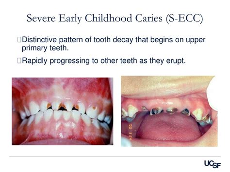 PPT - Early Childhood Caries Risk Assessment & Prevention Seminar ...