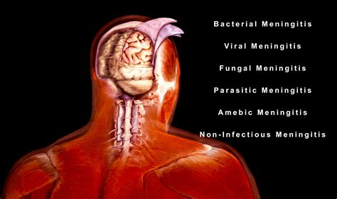 Viral Meningitis Rash Pictures Shingles rash in leukaemia patient - Stock Image M260/0421 ...