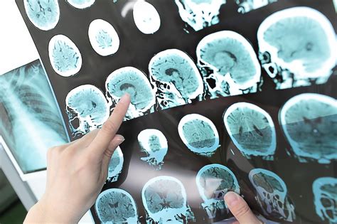 Accidente cerebrovascular hemorrágico: MedlinePlus en español