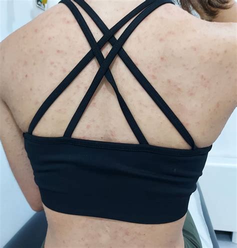 Pityriasis rosea in children - cases reports and review | Pediatric ...