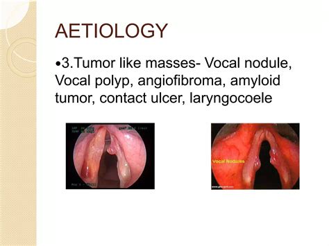 Hoarseness of voice | PPTX