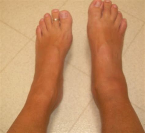 Here, swelling has set in on my right ankle. Images - Frompo