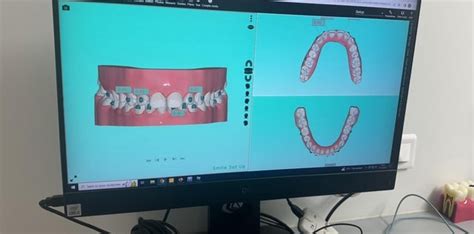 Image result for Invisalign ClinCheck