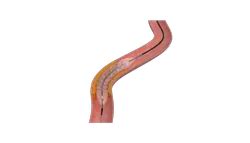 Drug Eluting Coronary Stent - EverPro - Drug Eluting Coronary Stent ...
