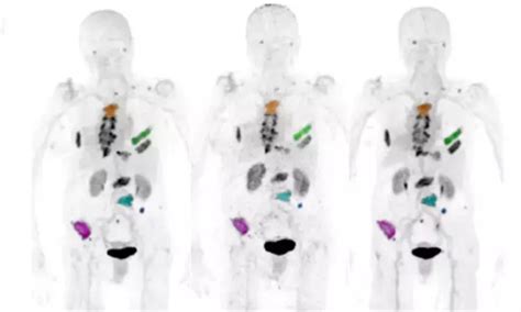 Ga-68 radiotracer better than FDG for diagnosing liver cancer: Study