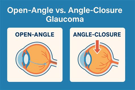 Open-Angle vs. Angle-Closure Glaucoma: Key Differences You Should Know