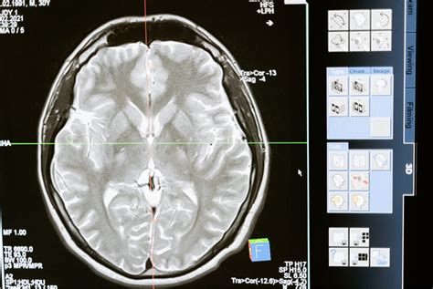 What Are Punitive Damages - Definition And Examples