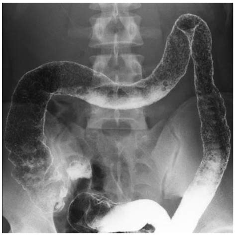 Infliximab and Plant-Based Diet as First-Line Therapy Followed by ...