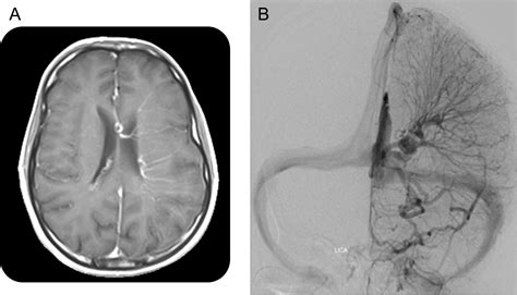 Teaching NeuroImages: A giant developmental venous anomaly in the ...
