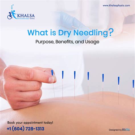 What is Dry Needling? - Purpose, Benefits, and Usage