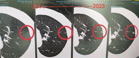 If the doctor only tells you: this ground glass nodule in the lung is ...