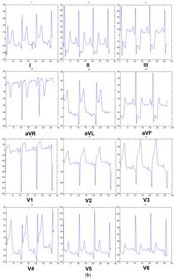 Sensors | Special Issue : ECG Sensors