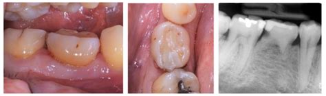 Immediate versus Delayed Implant Placement in Patients with Tooth ...