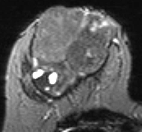 Differentiation of Phyllodes Breast Tumors from Fibroadenomas on MRI | AJR