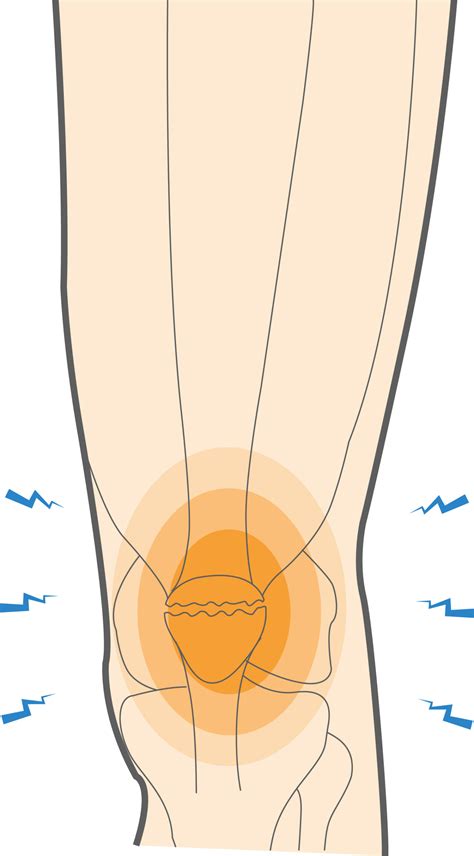 Signs Of Fracture Knee