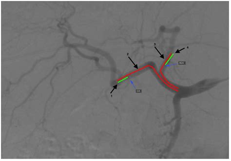 Left Gastric Artery Angiogram