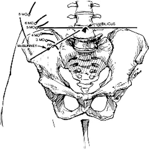 Appendicitis in Pregnancy | American Board of Family Medicine
