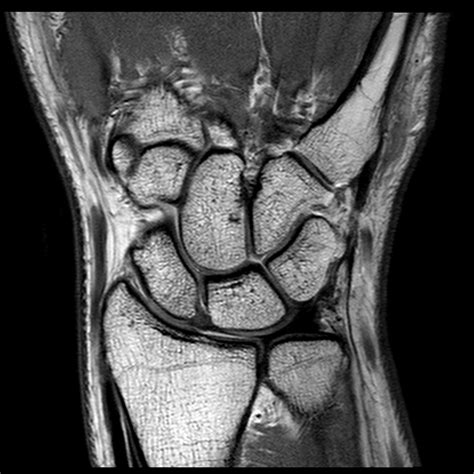 Mri Wrist Joint