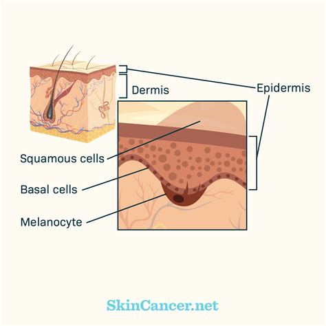 Image result for How Skin Cancer Forms