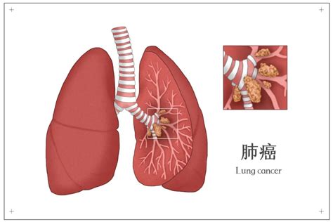 肺癌治疗进入3.0时代：奥希替尼正式获批中国EGFR突变晚期非小细胞肺癌的一线治疗_患者