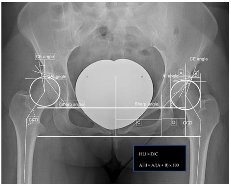 The Impact of the Laterality on Radiographic Outcomes of the Bernese ...