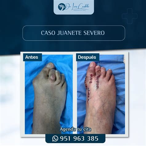 TÉCNICAS QUIRÚRGICAS DE JUANETES – Dr. Luis Castillo