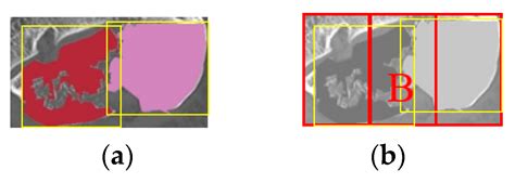 Real-Time Automated Segmentation and Classification of Calcaneal ...